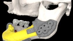 3D-protesi-mandibola-paziente-con-osteonecrosi-250x141