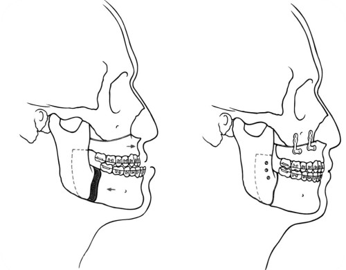 chirurgia mandibola asimmetrica2